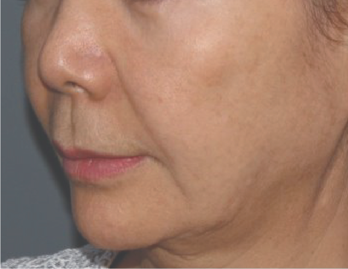 Density by Jeisys Before RF Treatment | Dual-Mode Monopolar & Bipolar RF Treatment Device | Advanced Energy-Based RF Treatment For Providers to Enhance Patient Satisfaction