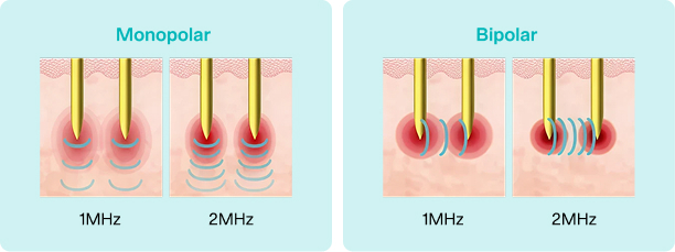 Potenza monopolar vs bipolar RF microneedling modes - 1MHz and 2MHz energy delivery comparison