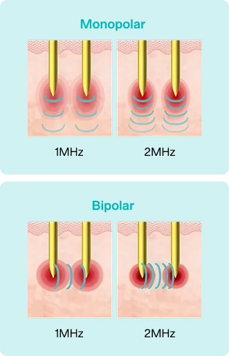 Potenza monopolar vs bipolar RF microneedling modes - 1MHz and 2MHz energy delivery comparison