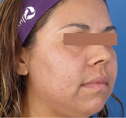 Improved skin clarity and reduced hyperpigmentation 4 weeks after Edge ONE CO2 treatment