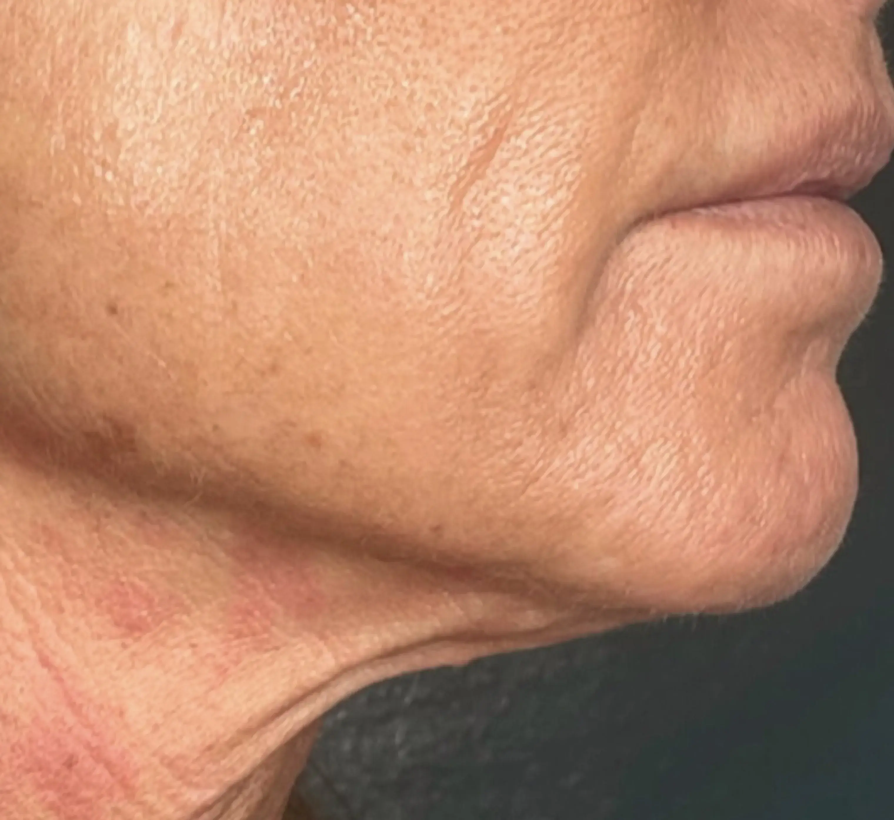 1_InnovativeBeauty_Neck_After