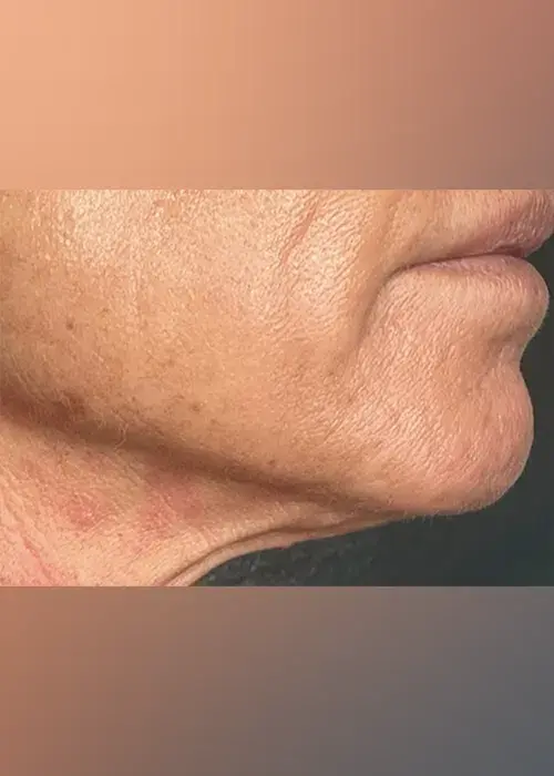 1_InnovativeBeauty_Neck_After_Mobile-1