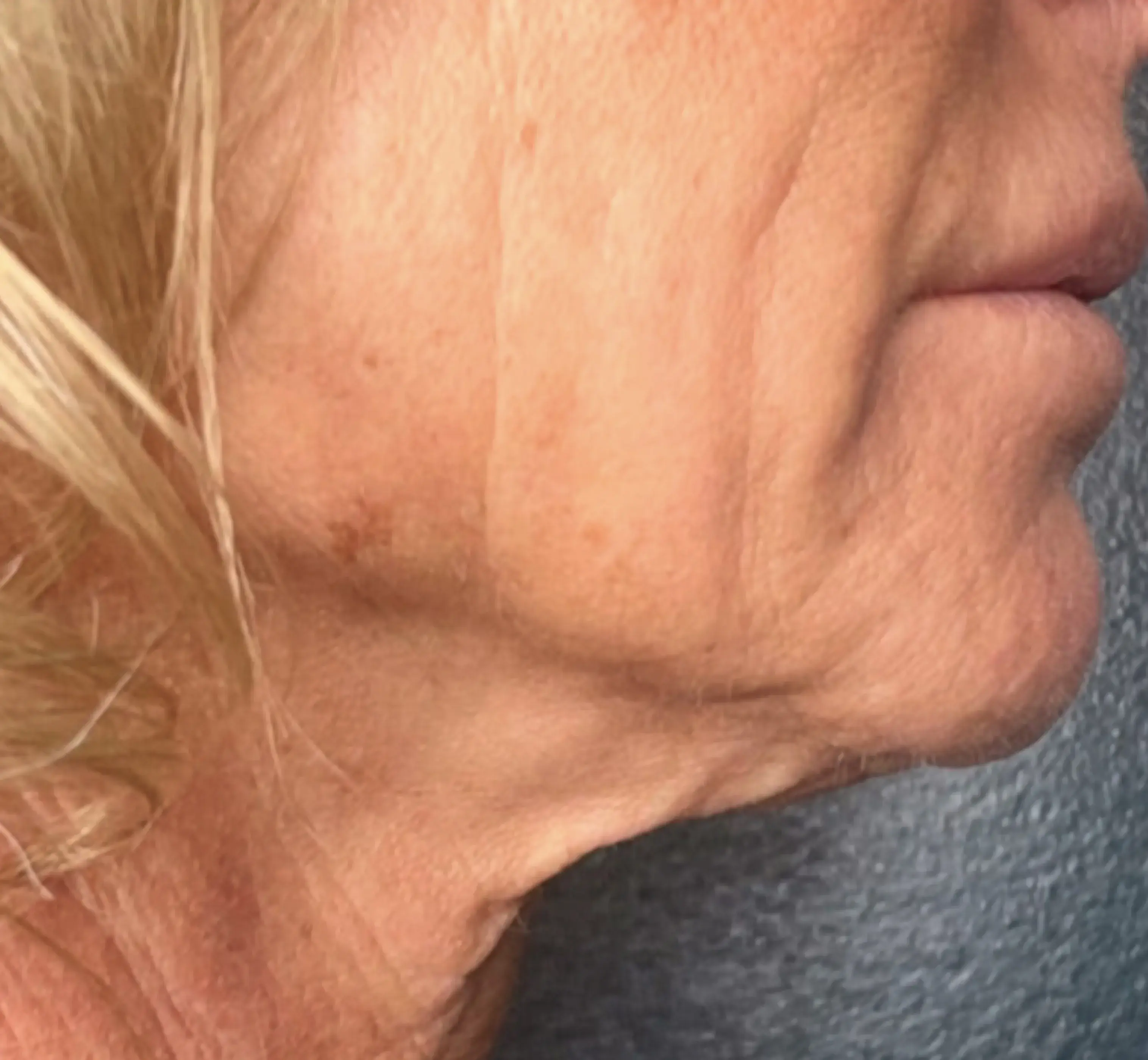 1_InnovativeBeauty_Neck_Before