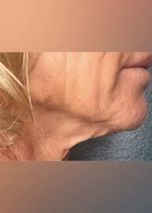 1_InnovativeBeauty_Neck_Before_Mobile-1