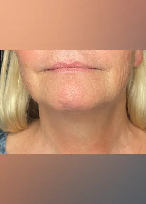 2_Innovative Beauty_Neck_After_Mobile-1