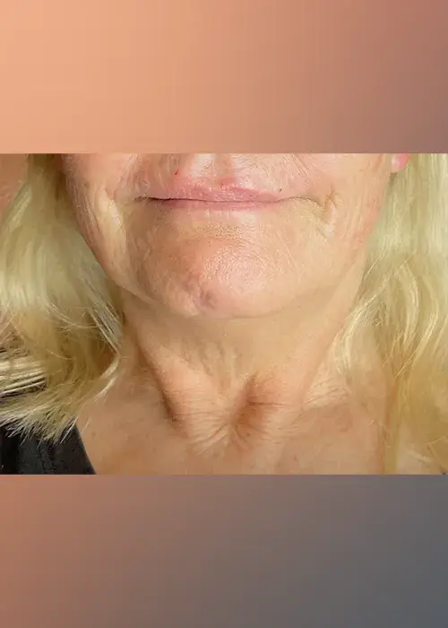 2_Innovative Beauty_Neck_Before_Mobile-1