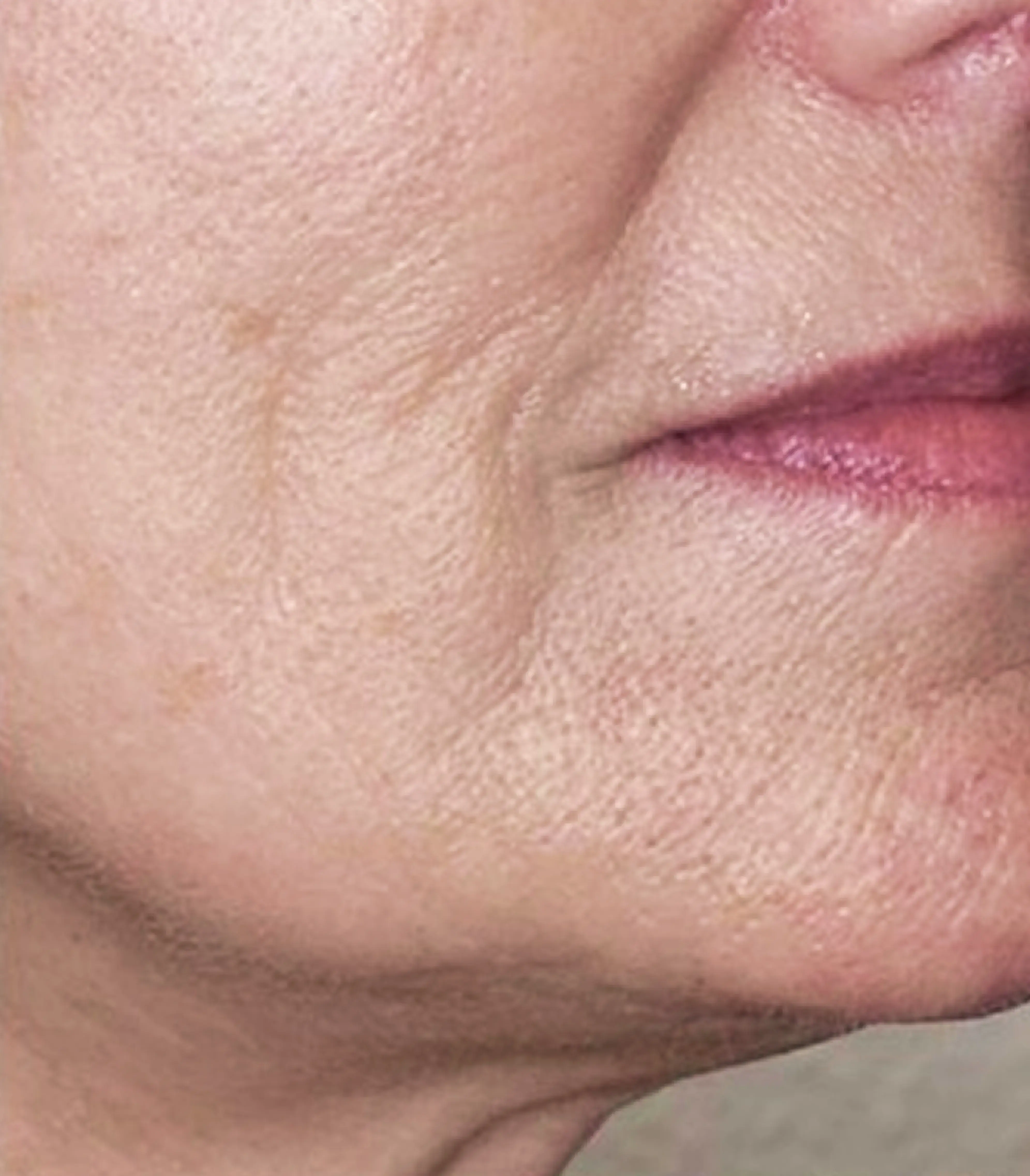 3_Bellagena_Neck_After