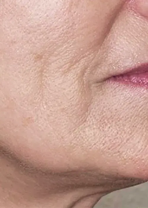 3_Bellagena_Neck_After_Mobile