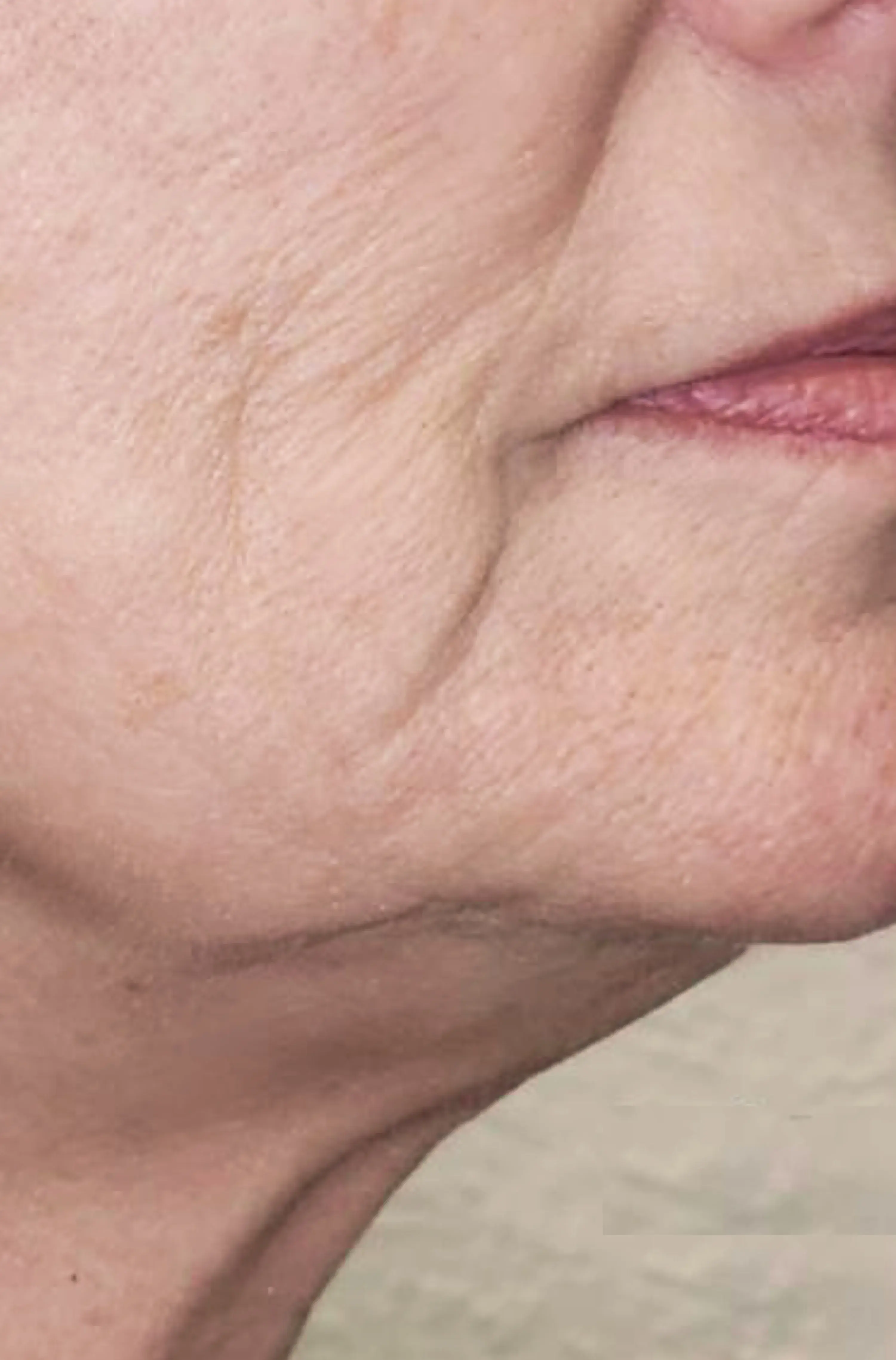 3_Bellagena_Neck_Before