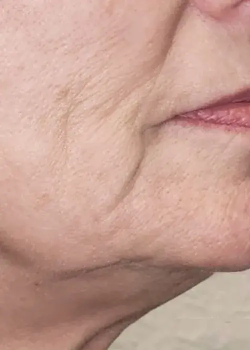 3_Bellagena_Neck_Before_Mobile