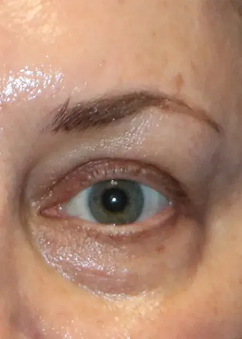 5_Eyes2_After_Mobile