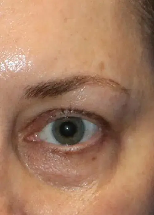 5_Eyes2_Before_Mobile