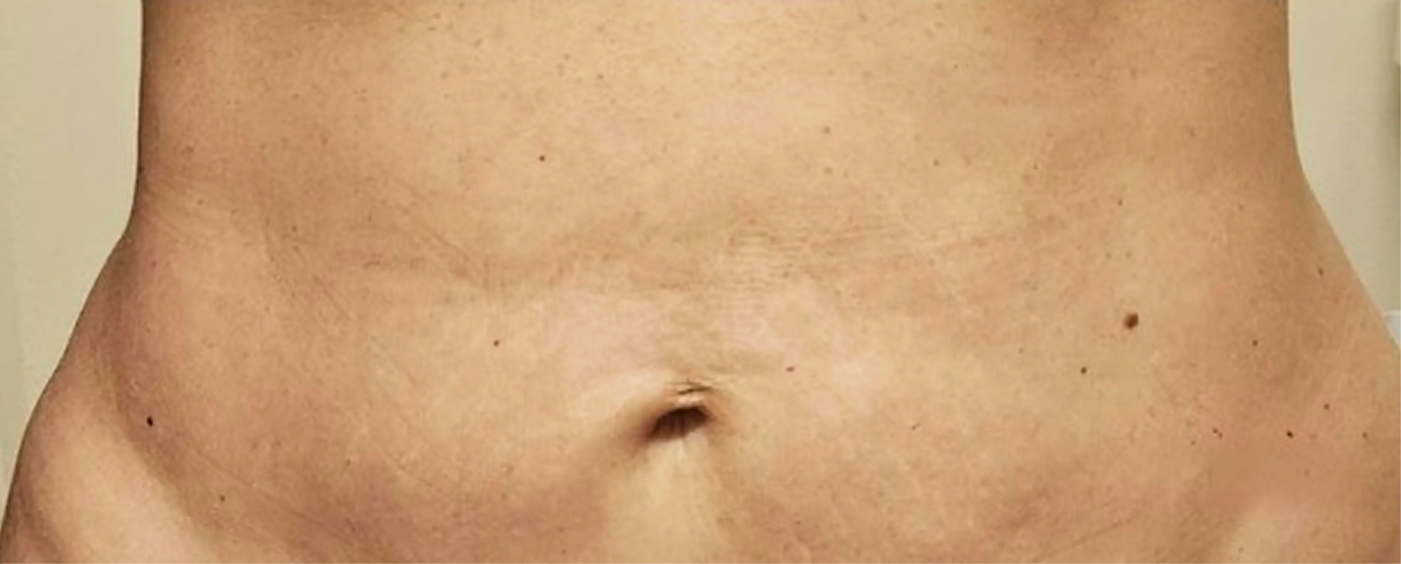 6_Bellagena_Stomach_After