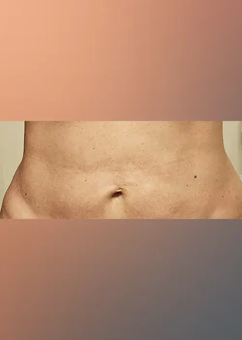 6_Bellagena_Stomach_After_Mobile-1