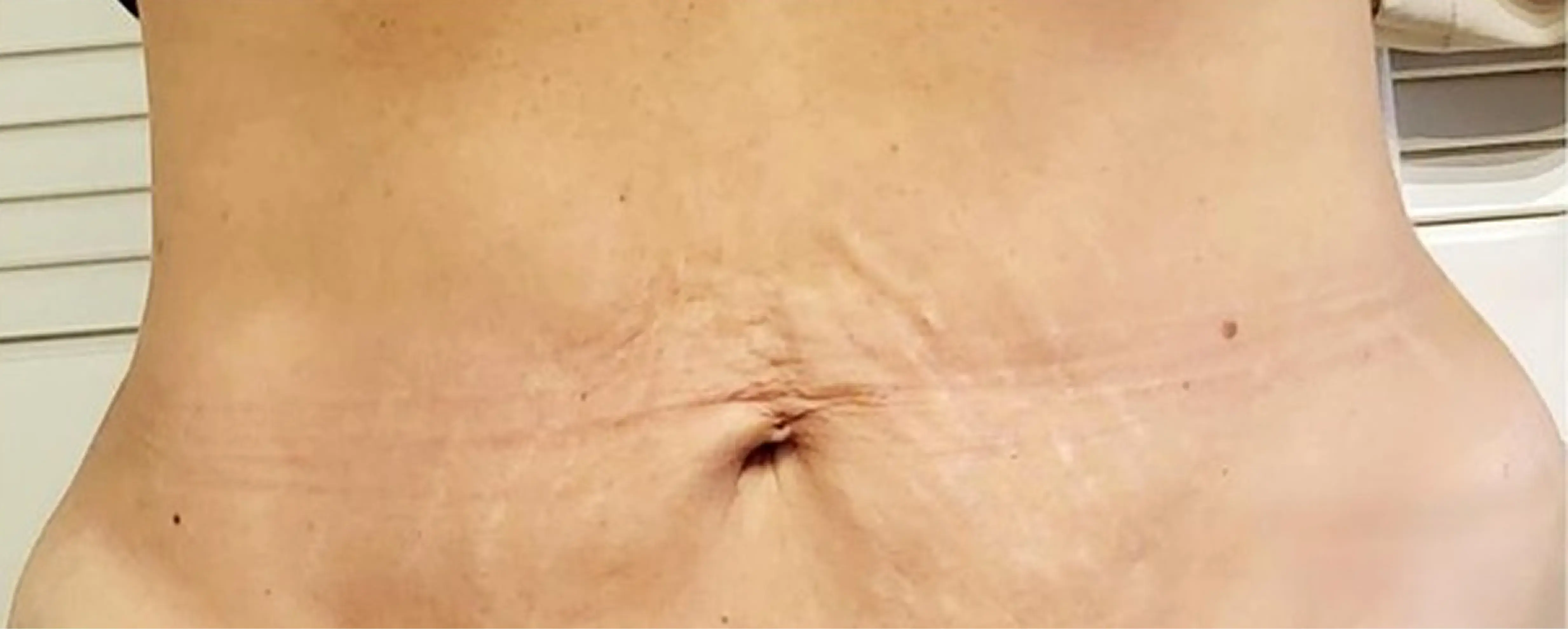 6_Bellagena_Stomach_Before