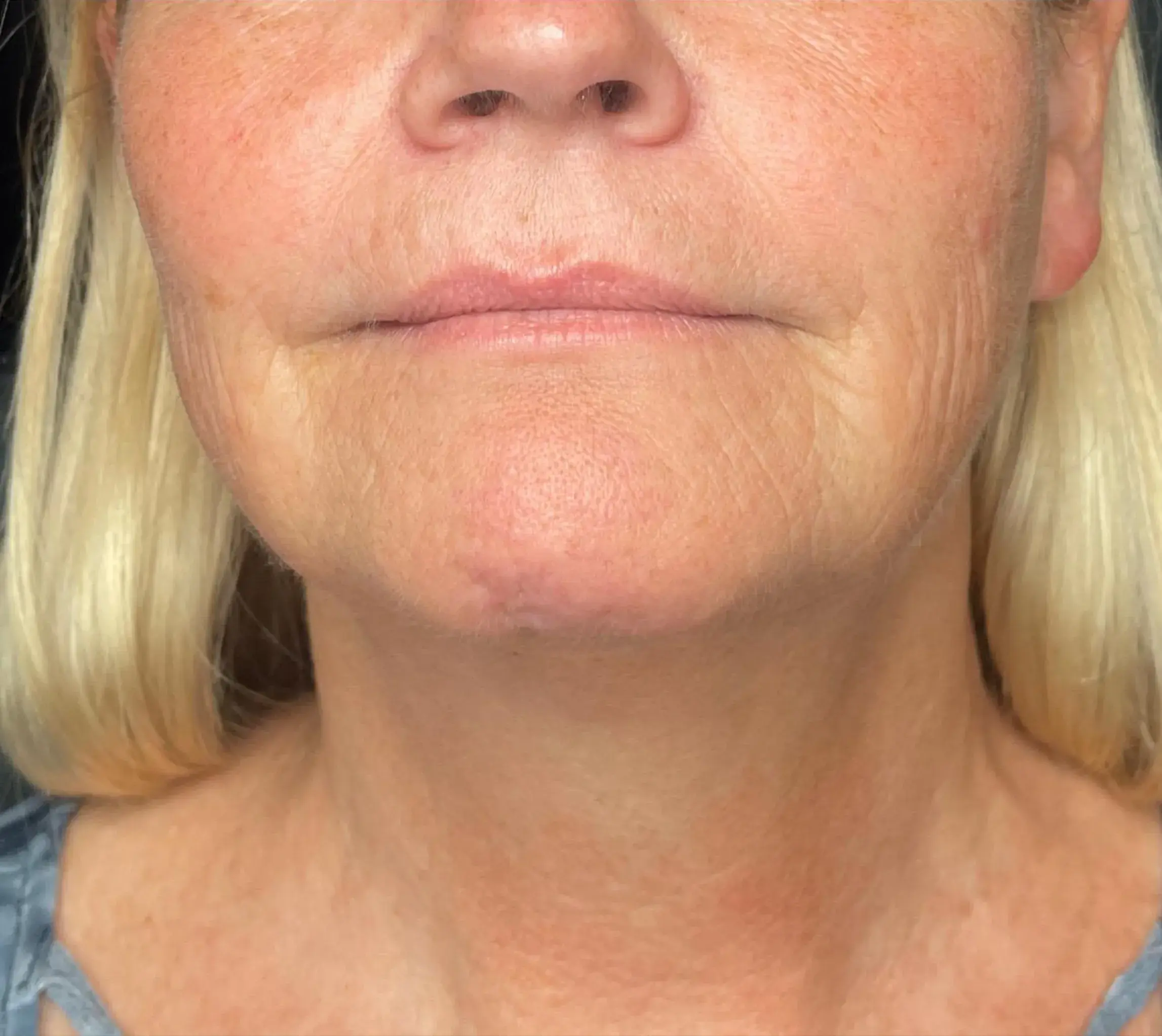 2_Innovative Beauty_Neck_After