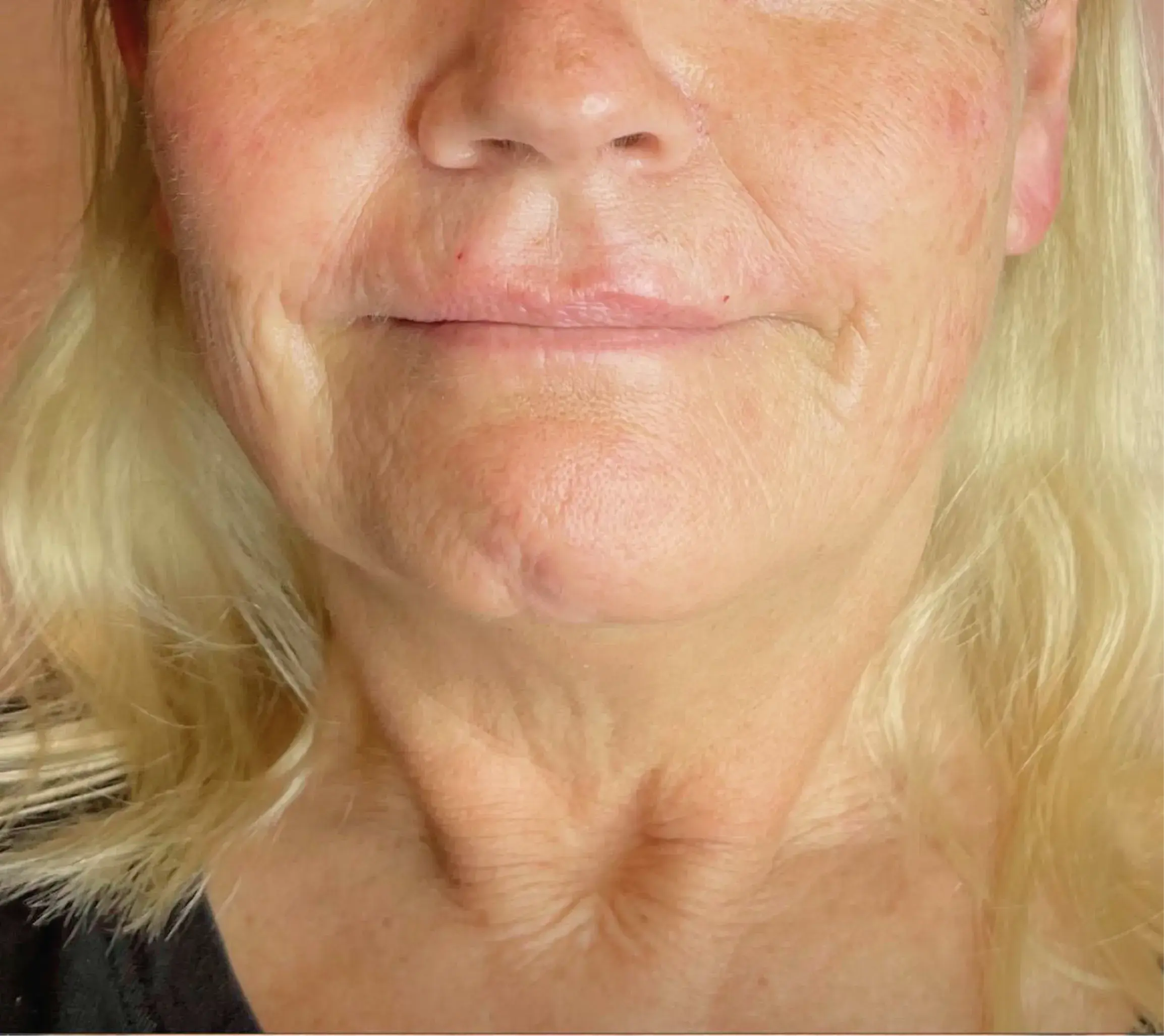 2_Innovative Beauty_Neck_Before